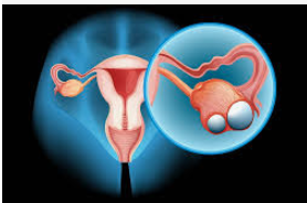 Cistos ovariano - Cistos ovariano: Como curar usando ervas e suplementos naturais?